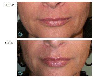 Before & After Lip Sculpting