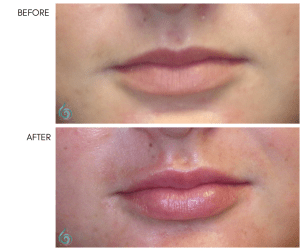 Before & After Lip Sculpting