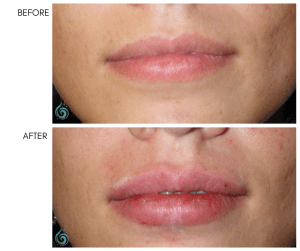 Before & After Lip Sculpting