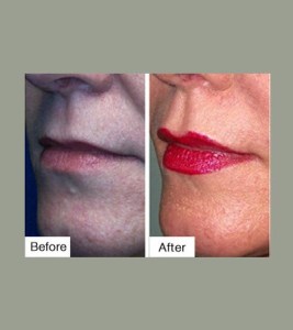 Before & After Lip Sculpting