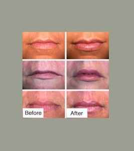 Before & After Lip Sculpting