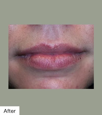 After Lip Sculpting