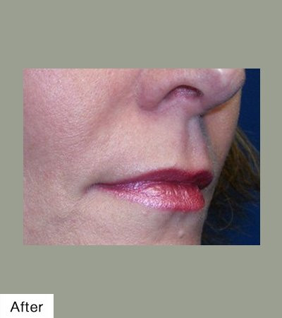 After Lip Sculpting