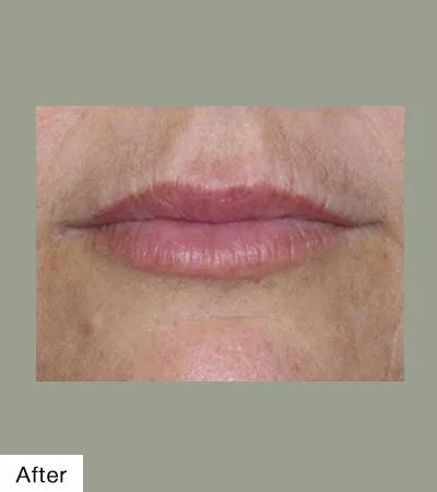 after Lip Sculpting