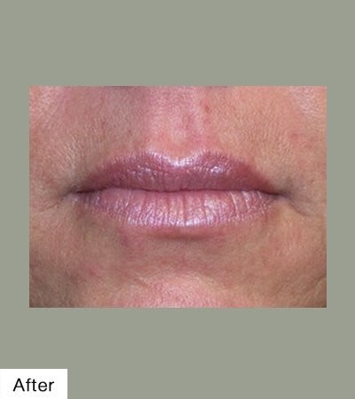 After Lip Sculpting