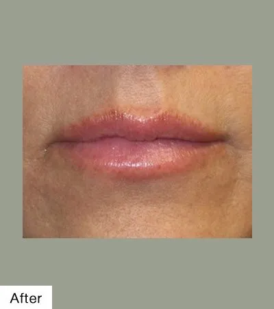 After Lip Sculpting