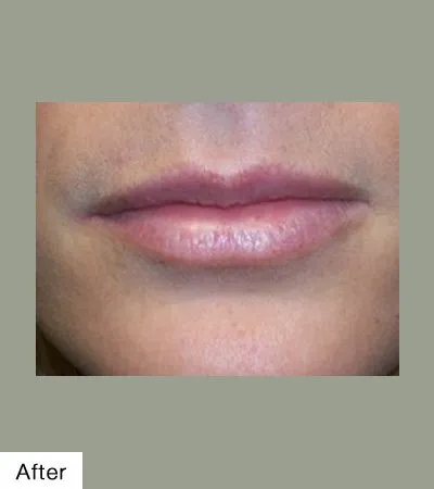 AFter Lip Sculpting