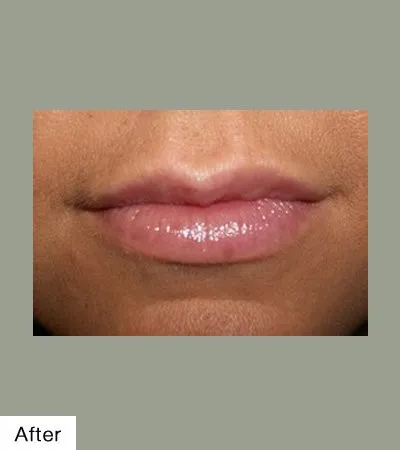 After Lip Sculpting