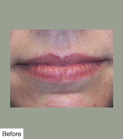 Before Lip Sculpting