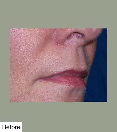 Before Lip Sculpting