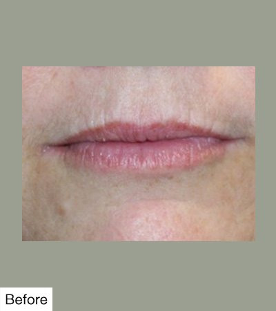 Before Lip Sculpting