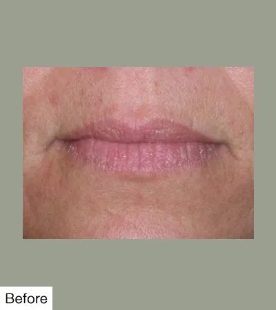 Before Lip Sculpting