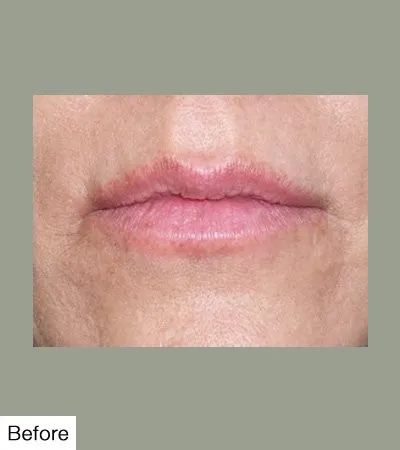 Before Lip Sculpting