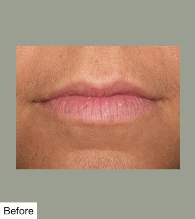 Before Lip Sculpting