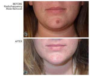 after Mole Removal