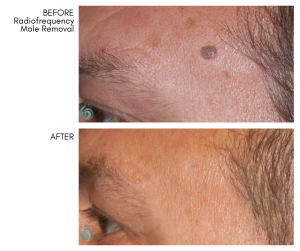 Mole Removal