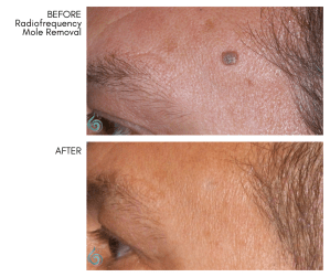 Mole Removal