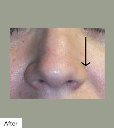 after Mole Removal