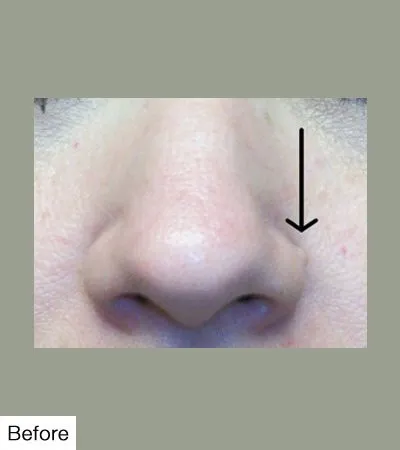 before Mole Removal