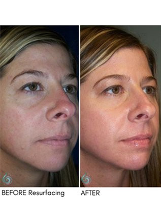 facial resurfacing