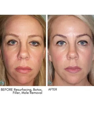 Injectables & Filler Before & After