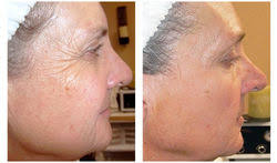 Facial Osmosis before and after